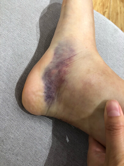 南洋理通:"用个几天才来评论,药不错,不小心扭伤脚了,很严重,医院检查