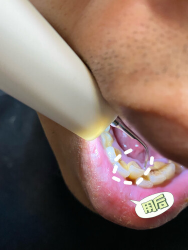 老司机介绍冲牙器HYUNDAI可视洁牙器评测结果怎么样？不值得买吗？