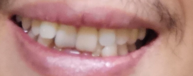 素诺SUNUO牙齿上的黑的和黄的能清理干净吗？