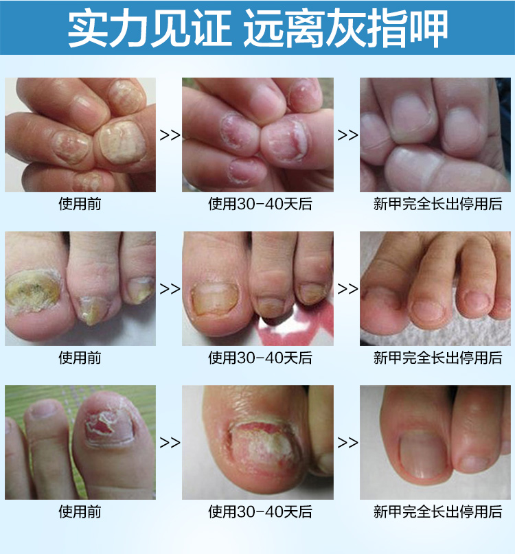 【芊茗草酶解凝胶】芊茗草酶解凝胶5ml 修护膜10ml套装(亮甲去灰指甲