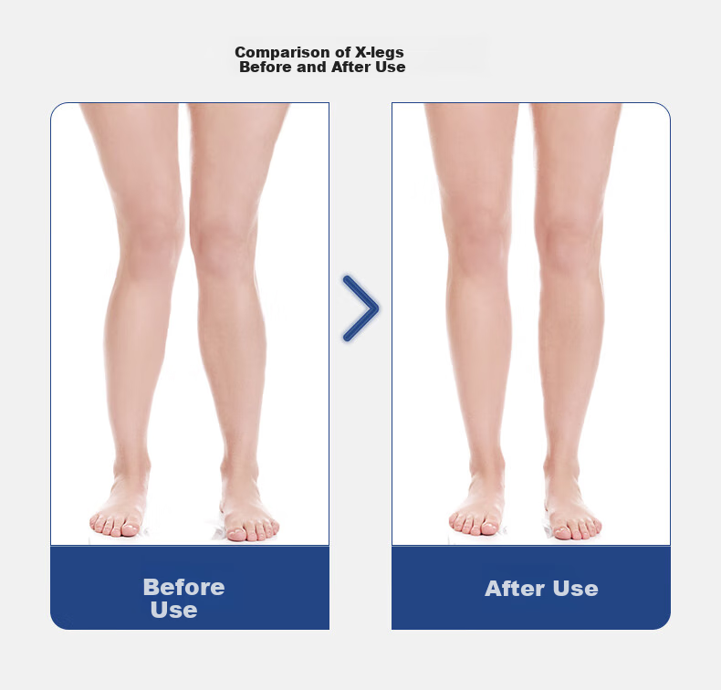 FOOTOPPO Magnetic X-Shaped Leg Insoles for Overlapping Legs, O-Shaped Legs, And X-Shaped Legs for Adults 9