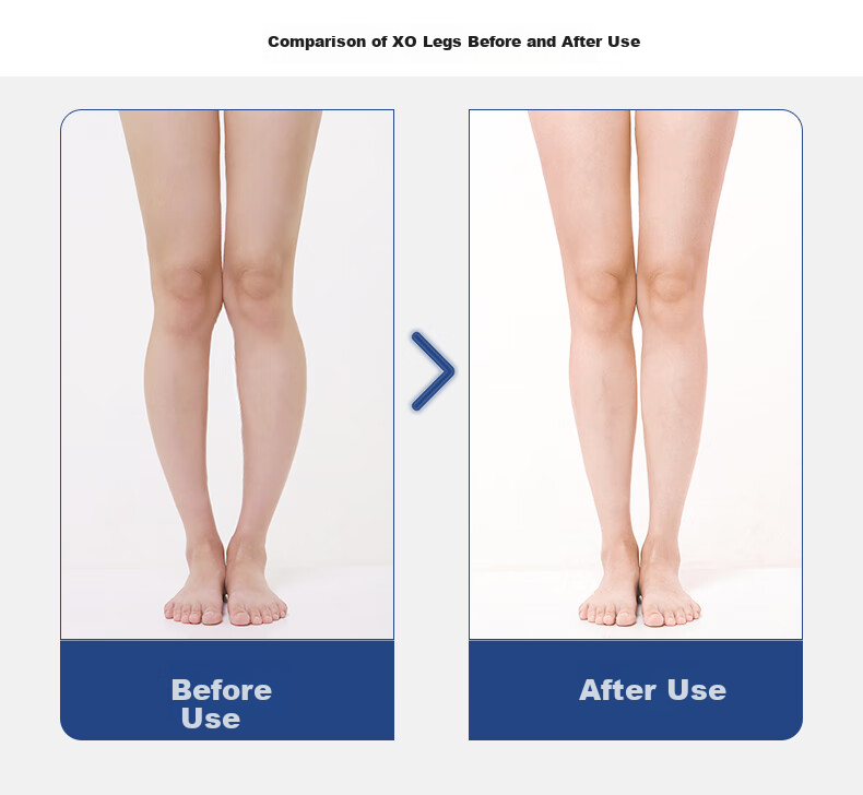 FOOTOPPO Magnetic X-Shaped Leg Insoles for Overlapping Legs, O-Shaped Legs, And X-Shaped Legs for Adults 8