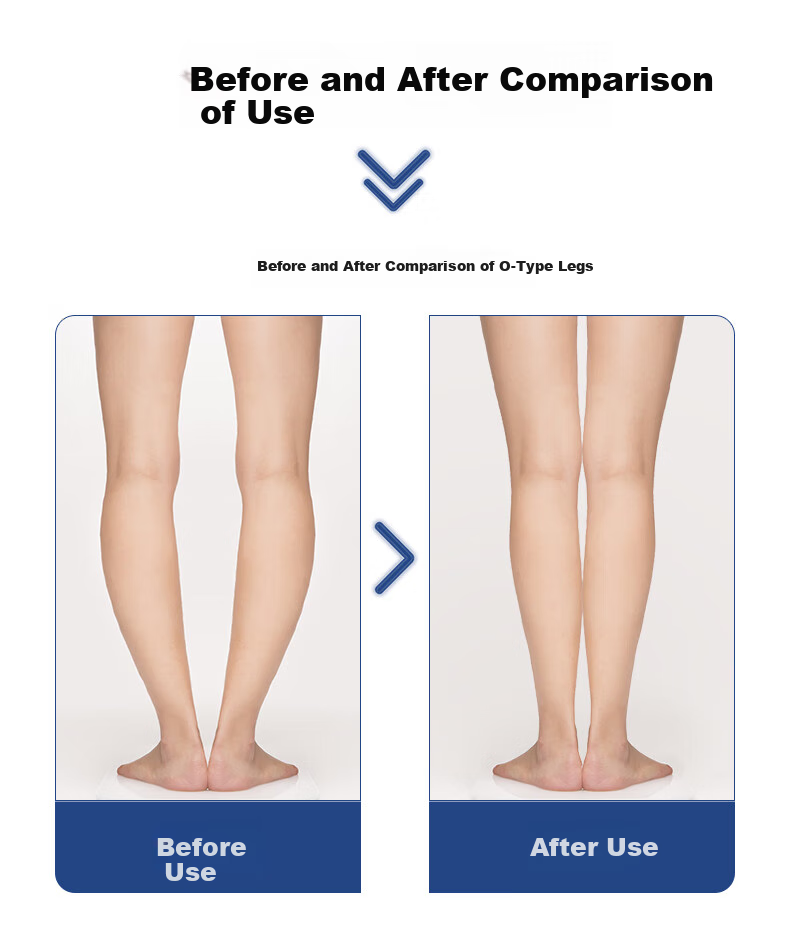 FOOTOPPO Magnetic X-Shaped Leg Insoles for Overlapping Legs, O-Shaped Legs, And X-Shaped Legs for Adults 7