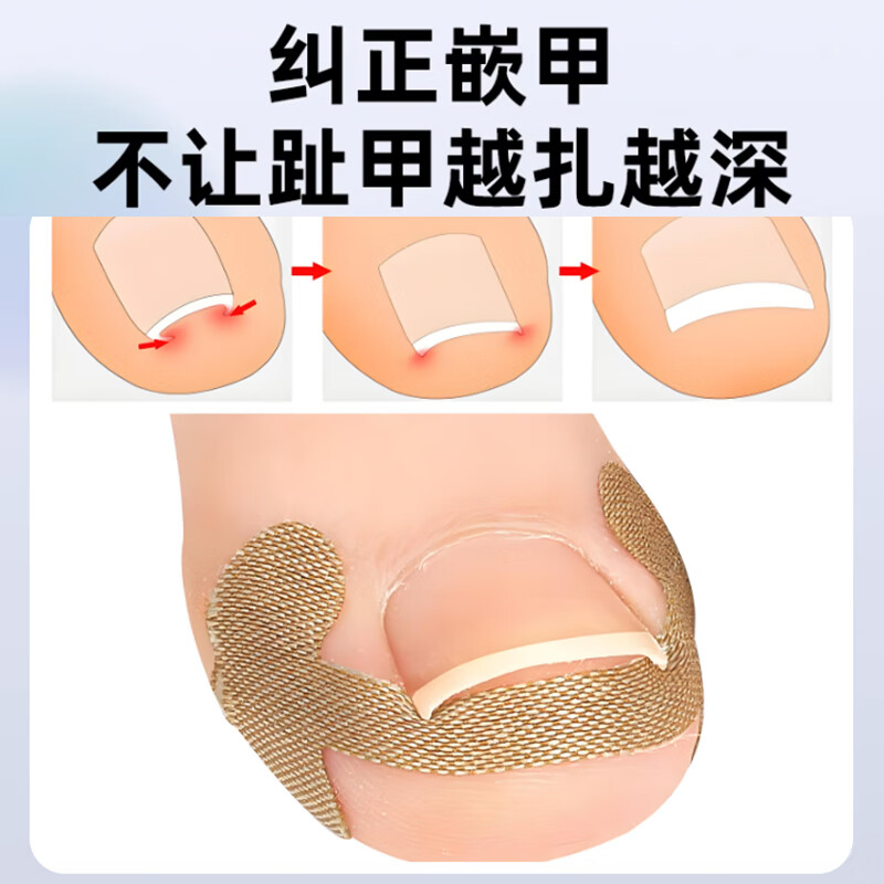 Xingfutang Ingrown Toenail Corrector Patch Tool for Preventing Toenail from Growing into Flesh Isolation Spacer Pad