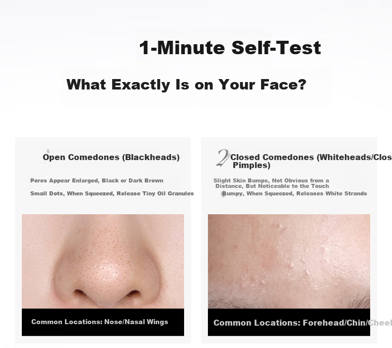 Tweezerman Imported Blackhead Remover No-Needle Design Whitehead Extractor Acne Pimple Tweezer Gift 13