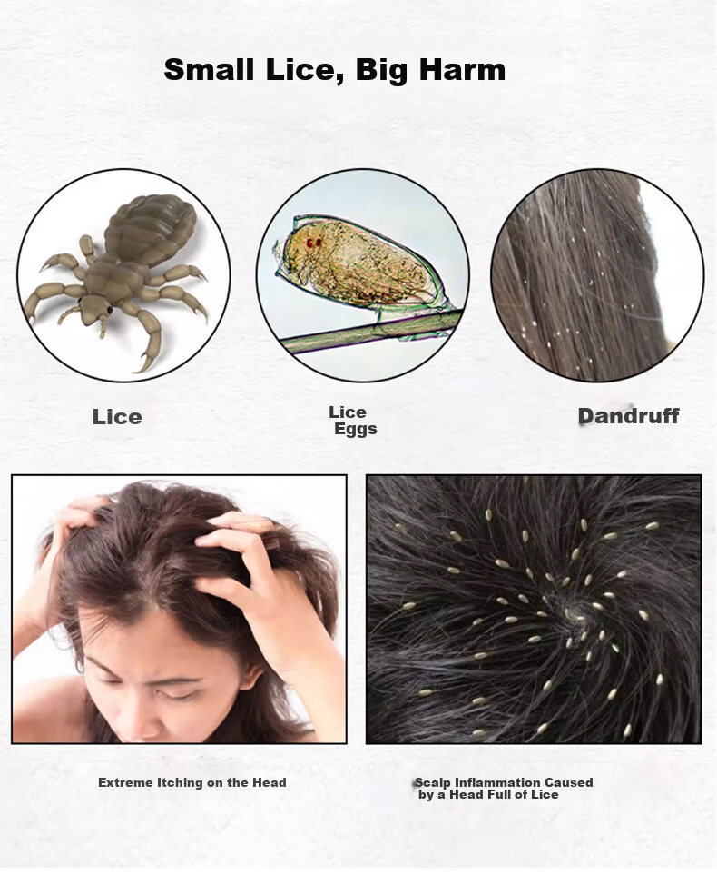Chense Lice Comb and Hair Tie Set - Ultra-Dense Fine Tooth Comb for Removing Lice Eggs, Dandruff, and Head Lice 4