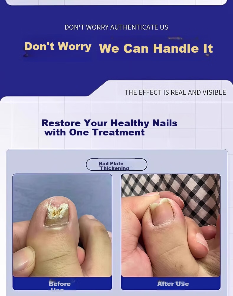 Mattetong Gray Toenail Phototherapy Lamp Smart Gray Toenail Laser Fungus Treatment Device Foot Nail Sterilization Lamp 6