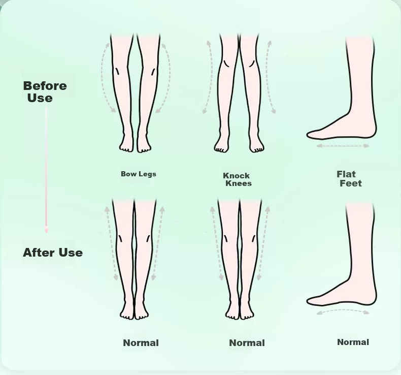 Gouge Whale Mat Professional Arch Support Insoles, Flat Foot Correction Insoles, Black, Size 45-46, 1 Pair 5