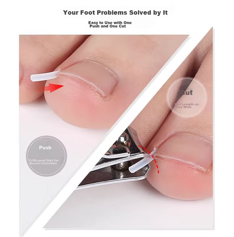 BAHAINIAO Ingrown Toenail Corrector Toe Nail Correction Separator Padding Tool for Ingrown Toenail Trimming 2