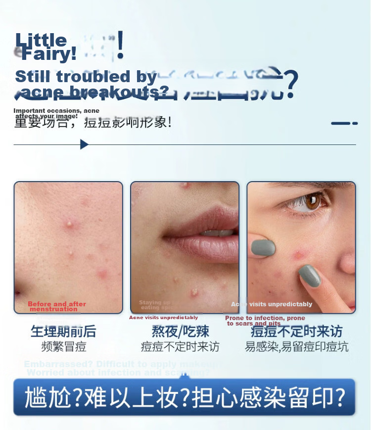 Huanlinkai Acne Needle, Blackhead Extractor, Pimple Popper, Comedone Remover, Acne Treatment Tool, Cleansing Instrument 2