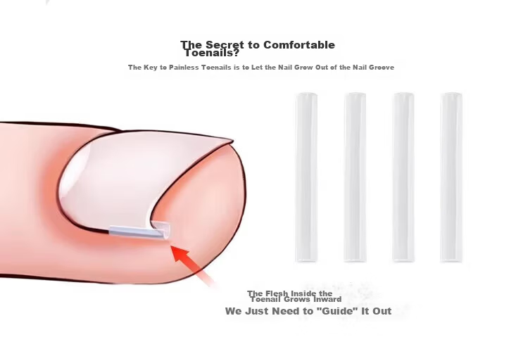 BAHAINIAO Ingrown Toenail Corrector Toe Nail Correction Separator Padding Tool for Ingrown Toenail Trimming 3