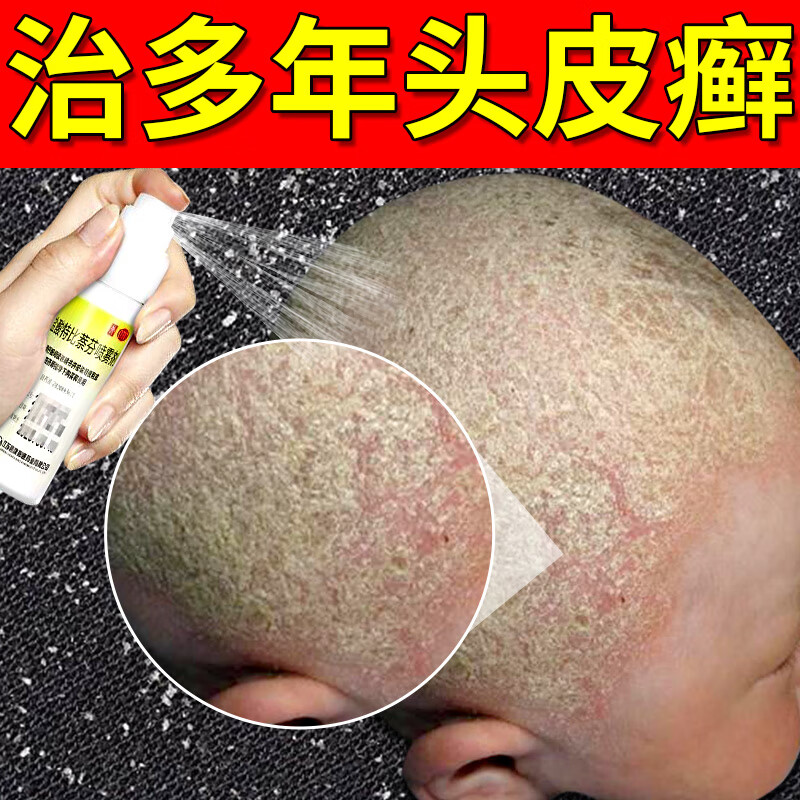 头癣头皮癣治脂溢性皮炎头癣喷剂黄癣白癣黑点癣脓癣银屑病头皮湿疹外